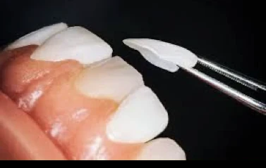 Carillas dentales en Alicante LUMINEERS - Clínica dental María Jiménez