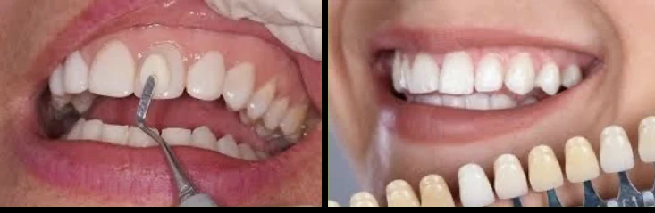 carillas dentales de composite en alicante clinica dental alicante