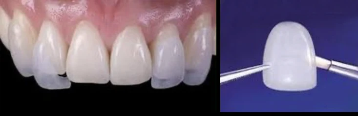 Carillas dentales en Alicante LUMINEERS - Clínica dental María Jimémez