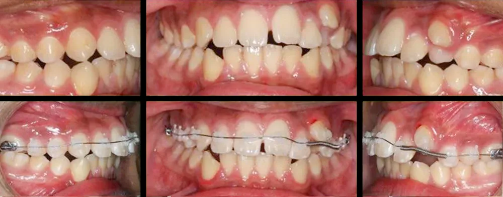 Ortodoncia brackets metálicos - clínica dental Alicante
