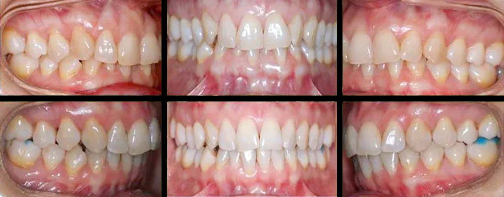 Ortodoncia alicante brackets metálicos - clínica dental Alicante