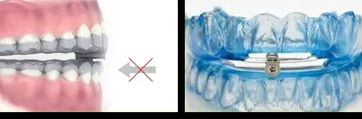 tratamiento-para-ronquidos-en-alicante-clinica dental