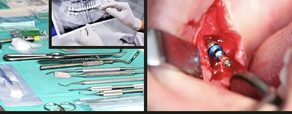 Cirujia oral en Clínica dental María Jiménez en Alicante