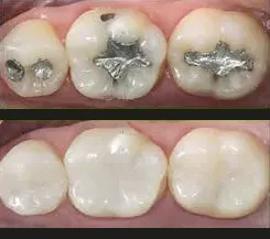 Odontología restauradora en Alicante - Clínica dental María Jiménez