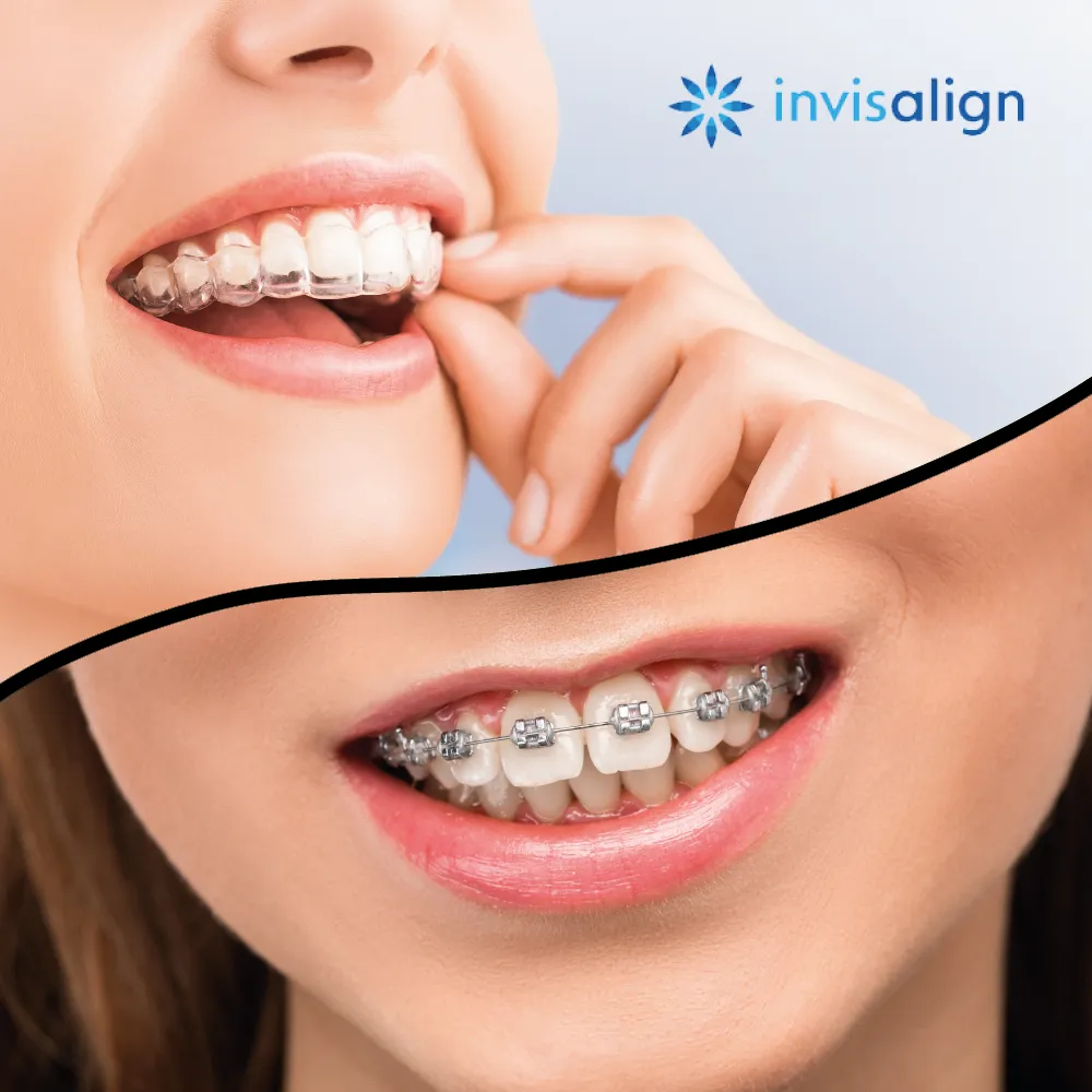 ortodoncia invisible y brackets metálicos en Clínica dental María Jiménez Alicante