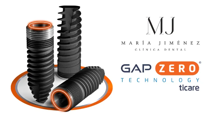 Implantes dentales ticare clínica dental María Jiménez en Alicante centro