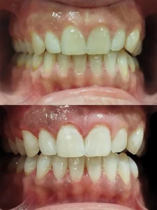 Blanqueamiento dental en un día - Clínica dental María Jiménez