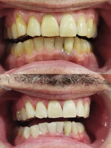 Blanqueamiento dental en un día - Clínica dental María Jiménez