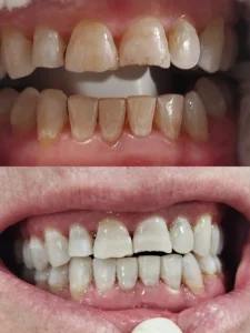 Blanqueamiento dental en un día - Clínica dental María Jiménez