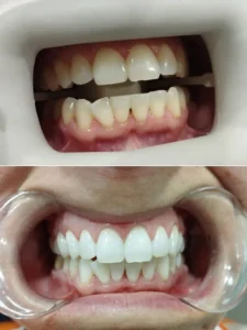 Blanqueamiento dental en un día - Clínica dental María Jiménez