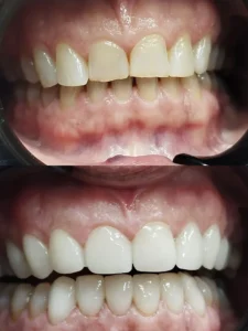 Carillas de porcelana - Clinica dental en Alicante - Clínica dental María Jiménez