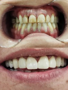 Carillas de porcelana Clinica dental en Alicante - Clínica dental María Jiménez