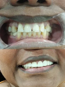 Coronas de Zirconio Clinica dental María Jiménez