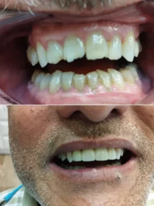 Coronas de porcelana Clinica dental en Alicante - Clínica dental María Jiménez