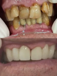 Coronas de zirconio - Clinica dental en Alicante - Clínica dental María Jiménez
