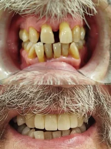 Implantes y coronas de zirconio zona anterior superior - Clinica dental en Alicante - Clínica dental María Jiménez