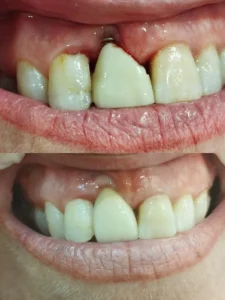 Injerto de encía Clinica dental en Alicante - Clínica dental María Jiménez