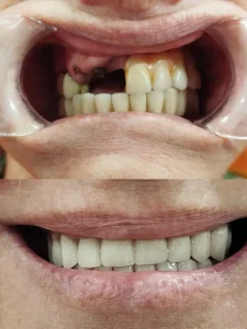 Prótesis de metal-porcelana superior sobre implantes Clinica dental en Alicante - Clínica dental María Jiménez