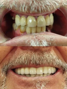 Prótesis metal-porcelana asobre implantes maxilar superior - Clinica dental en Alicante - Clínica dental María Jiménez