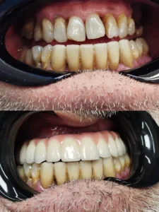 Prótesis sobre implantes de metal-porcelana del maxilar superior Clinica dental en Alicante - Clínica dental María Jiménez