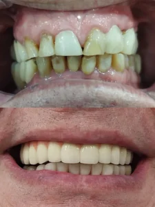 Prótesis sobre implantes de metal-porcelana maxilar superior Clinica dental en Alicante - Clínica dental María Jiménez