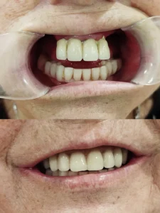 Prótesis sobre implantes maxilar superior - Clinica dental en Alicante - Clínica dental María Jiménez