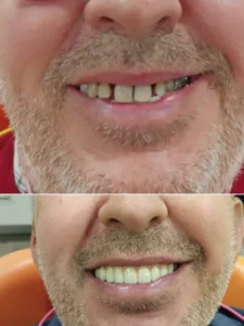 Prótesis sobre implantes superior - Clinica dental en Alicante - Clínica dental María Jiménez