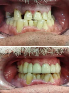 Rehabilitación superior con metal-porcelana y esquelético Clinica dental en Alicante - Clínica dental María Jiménez