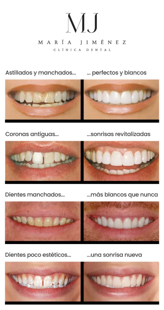 carillas dentales lumineers casos