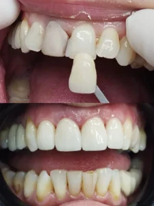 Carillas de silicato de litio