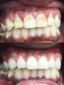 Obturaciones de composite - Caries producidas por bebidas azucaradas