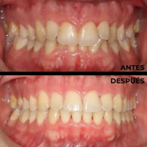 Ortodoncia real del antes y después en Clínica Dental en Alicante