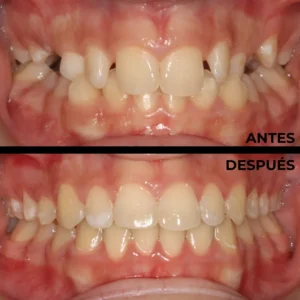 Ortodoncia real del antes y después en Clínica Dental en Alicante