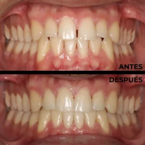 Ortodoncia real del antes y después en Clínica Dental en Alicante