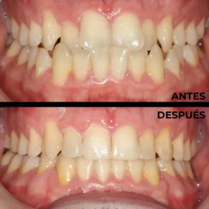 Ortodoncia real del antes y después en Clínica Dental en Alicante