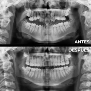 Ortodoncia real del antes y después en Clínica Dental en Alicante
