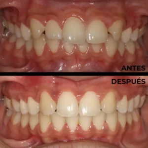 Ortodoncia real del antes y después en Clínica Dental en Alicante