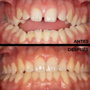 Ortodoncia real del antes y después en Clínica Dental en Alicante