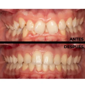 Ortodoncia real del antes y después en Clínica Dental en Alicante