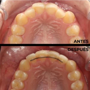 Ortodoncia real del antes y después en Clínica Dental en Alicante