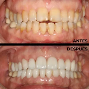 Ortodoncia real del antes y después en Clínica Dental en Alicante